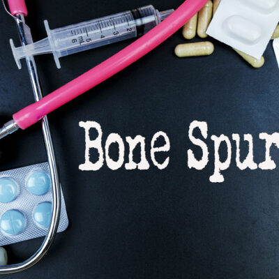 Bone Spurs – Causes, Types, and Management Options