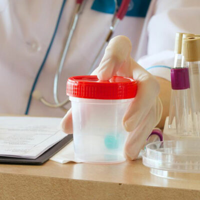 Proteinuria – The process of protein in urine test
