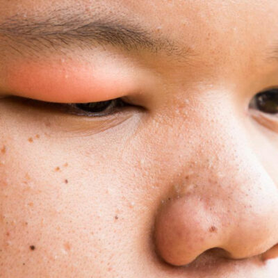 Here’s How to Get Rid of a Stye With These Simple Steps