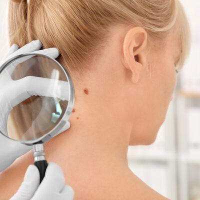 Worried About Skin Cancer Here’s What To Know