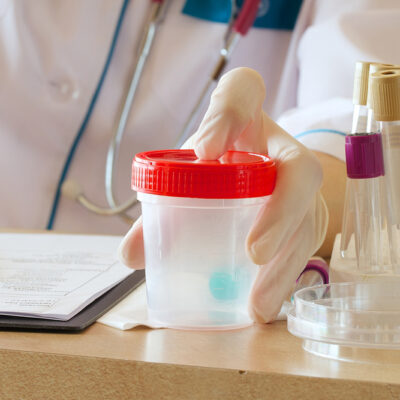 Cloudy Urine – Causes and Home Remedies